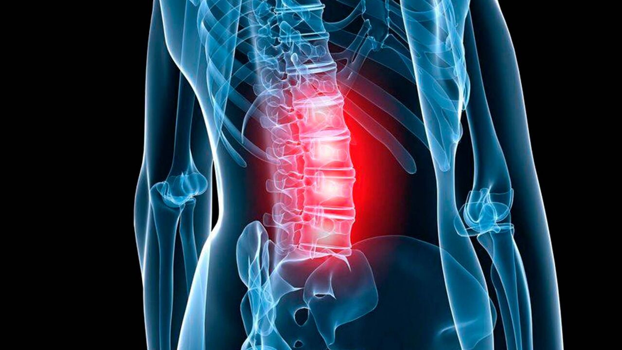 Symptomer vun der Lendeger Osteochondrose