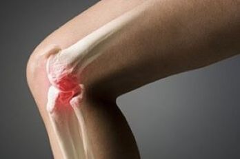Arthrosis vum Knéi Gelenk ass eng Läsion vu Knorpel