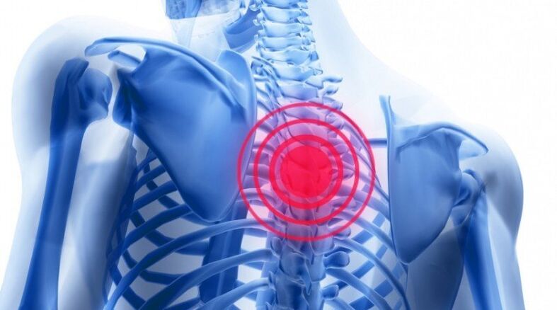 Réckschmerzen kann duerch eng herniated disc ginn