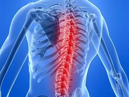 Spinal Krankheet verursaacht Réckschmerzen
