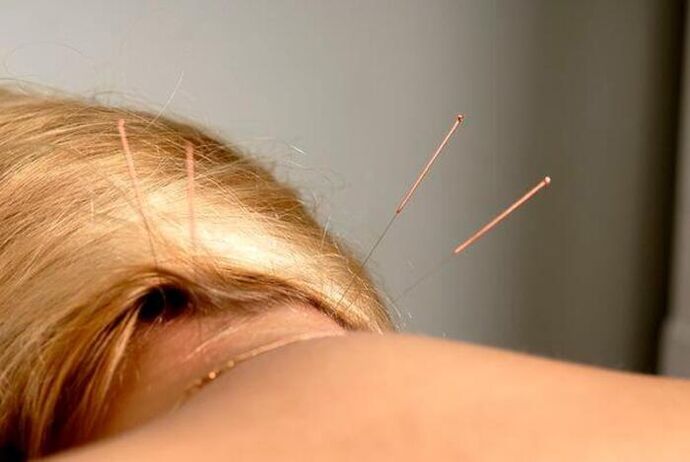 Akupunktur fir Osteochondrose