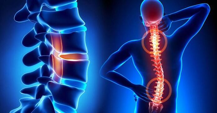 Lokaliséierung vu Schmerz bei Osteochondrose