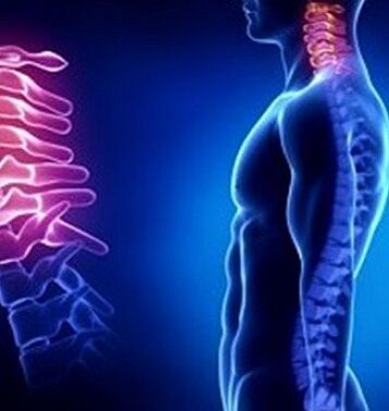 Zervikal Osteochondrose kann duerch Halsverletzungen verursaacht ginn