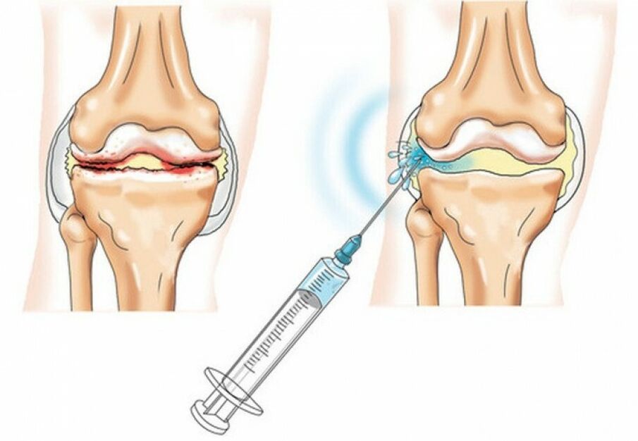 Injektioun am Knéi Gelenk mat Arthrosis