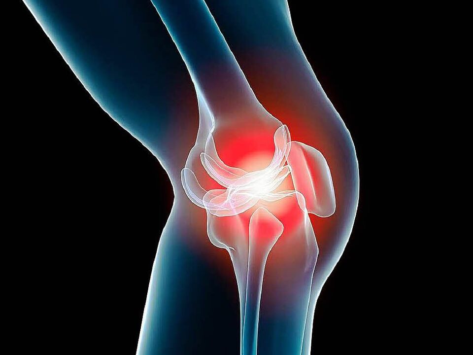 arthrosis vum Knéi