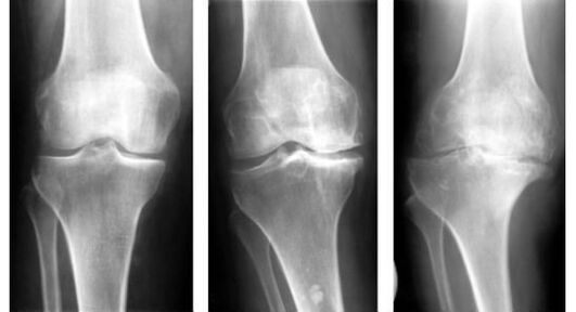 Eng obligatoresch diagnostesch Moossnam bei der Identifikatioun vun Arthrosis vum Knéi ass Röntgen